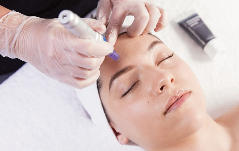Microneedling