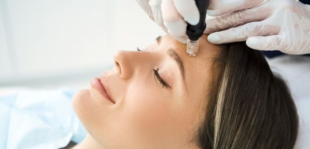 Microneedling